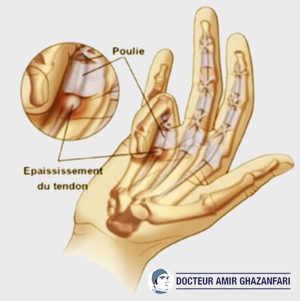 Doigt à ressaut - Figure 1. Épaississement du tendon fléchisseur avec création de nodule, responsable d'un conflit avec la poulie A1