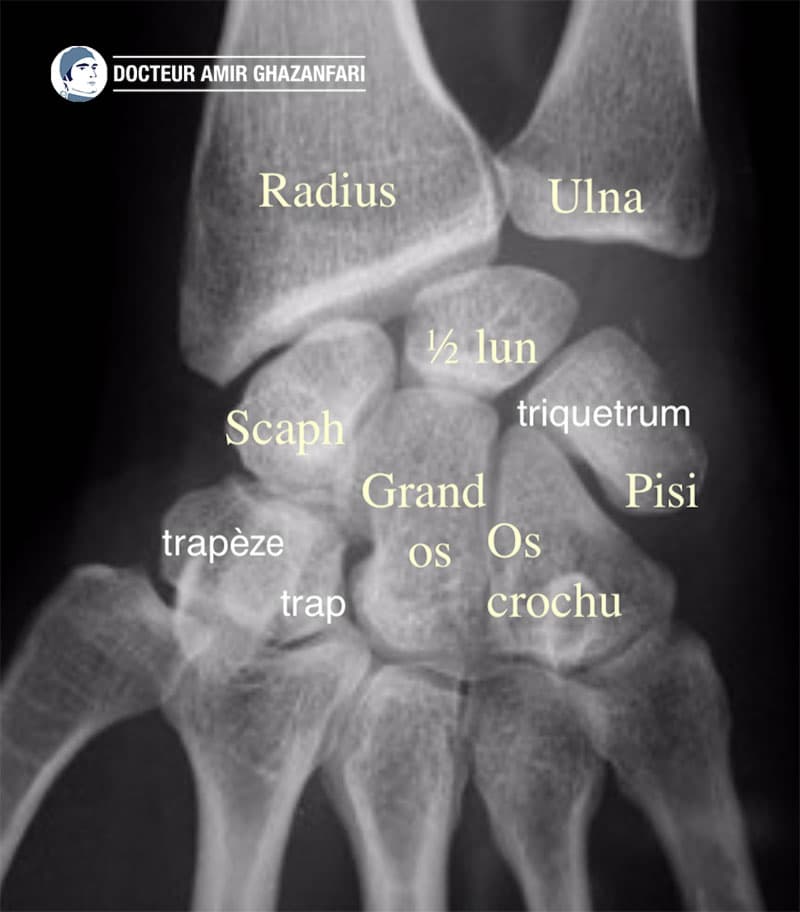 Pseudoarthrose du scaphoïde - Figure 1. Anatomie des os du poignet