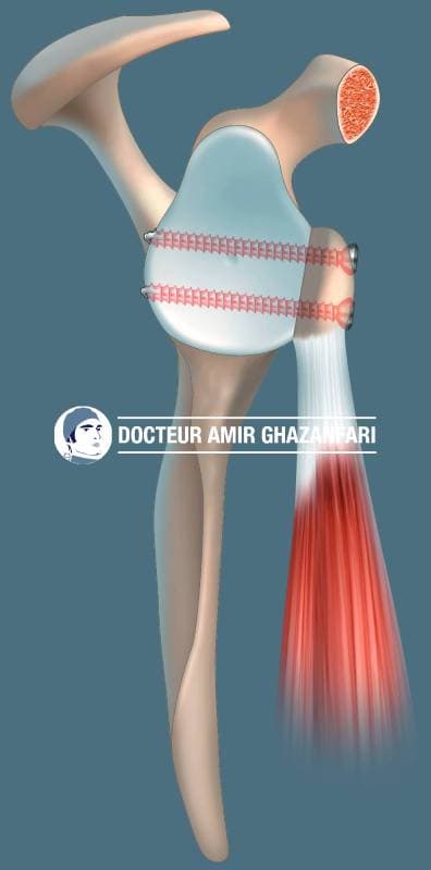 Image 2 Instabilité antérieure de l'épaule - Figure 10. Stabilisation chirurgicale de l'épaule par une butée osseuse selon Latarjet, prélevée sur la coracoïde