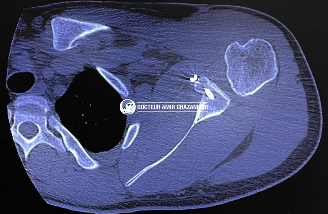 Instabilité antérieure de l'épaule - Figure 11. Scanner post-opératoire à 3 mois: butée en bonne position, fusionnée avec la glène