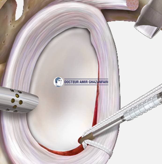 Image 1 Instabilité antérieure de l'épaule - Figure 12. Réinsertion du bourrelet glénoïdien sous arthroscopie par trois ancres