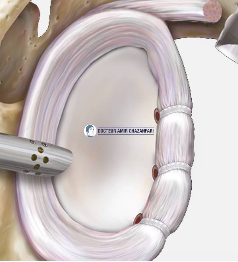 Image 2 Instabilité antérieure de l'épaule - Figure 12. Réinsertion du bourrelet glénoïdien sous arthroscopie par trois ancres