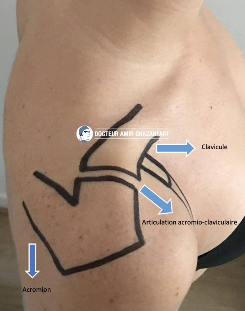 Arthrose acromio claviculaire - Figure 2. Repères osseux et articulation acromio-claviculaire