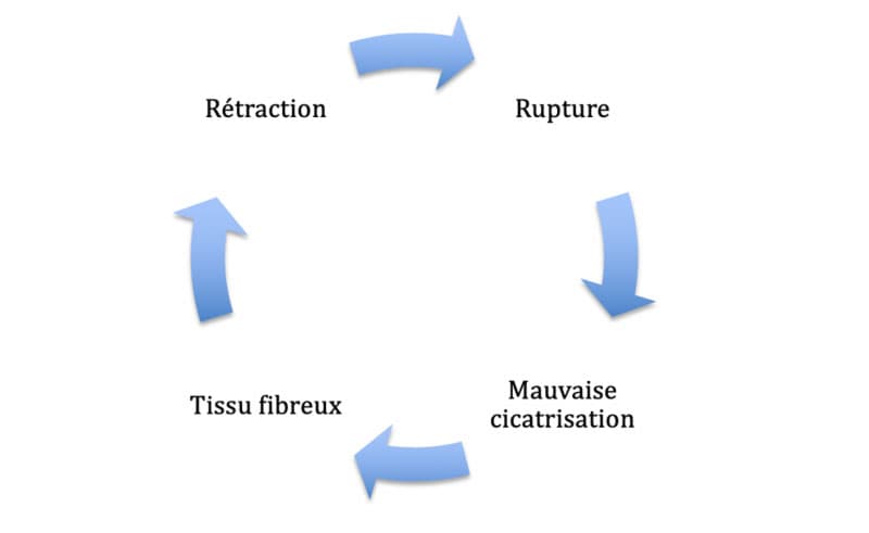 Epicondylite Laterale - Fgure 2. Cercle vicieux pérennisant l'épicondylite latérale en l'absence d'une prise en charge adaptée