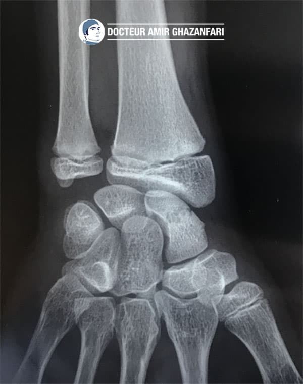 Pseudoarthrose du scaphoïde - Figure 2. Pseudarthrose du scaphoïde chez un adolescent. A noter la présence de cartilage de croissance au niveau du radius et de l'ulna.