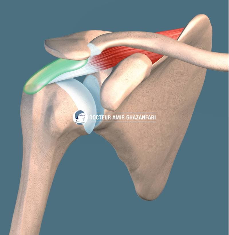 Image 1 Rupture de la coiffe des rotateurs - Figure 2. Conflit sous-acrominal par frottement de l'acromion sur la coiffe des rotateurs