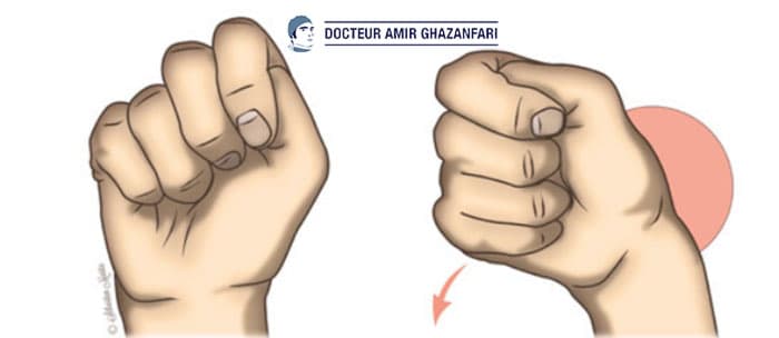 Tendinite de De Quervain - Figure 2. Test de Finkelstein: la flexion du pouce et l'inclinaison ulnaire du poignet reproduit la douleur