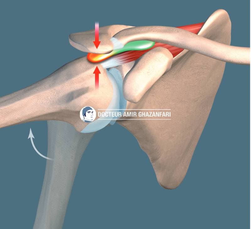 Image 2 Rupture de la coiffe des rotateurs - Figure 2. Conflit sous-acrominal par frottement de l'acromion sur la coiffe des rotateurs