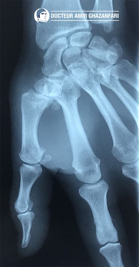 Arthrose du pouce - Figure 3. Rhizarthrose évoluée visualisée sur les clichés radiographiques