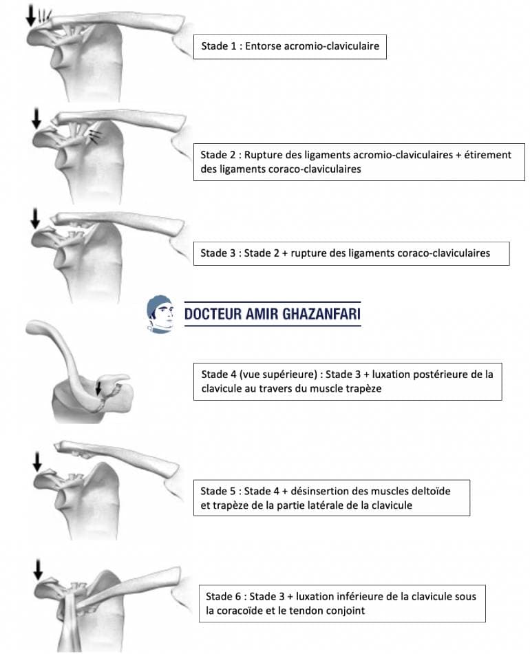 Disjonction acromio claviculaire - Figure 3. Différents stades de la classification de Rockwood