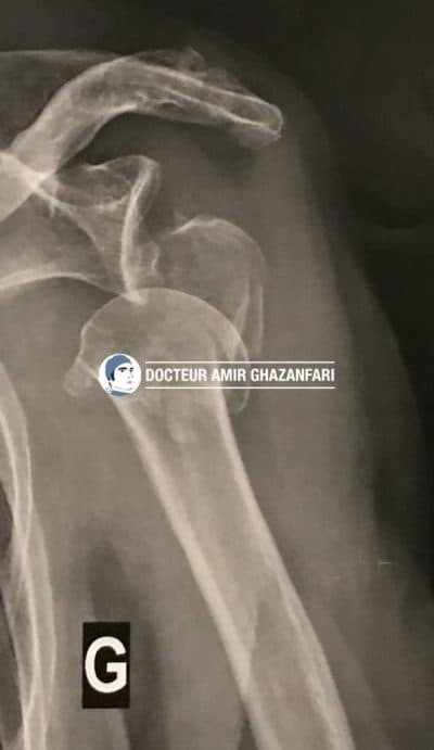 Prothèse d'épaule - Figure 3. Fracture complexe et déplacée de l'humérus, indication à la mise en place d'une prothèse d'épaule