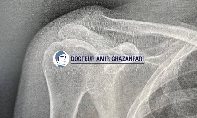 Arthrose acromio claviculaire - Figure 4. Radiographie de face: arthrose acrromio-claviculaire