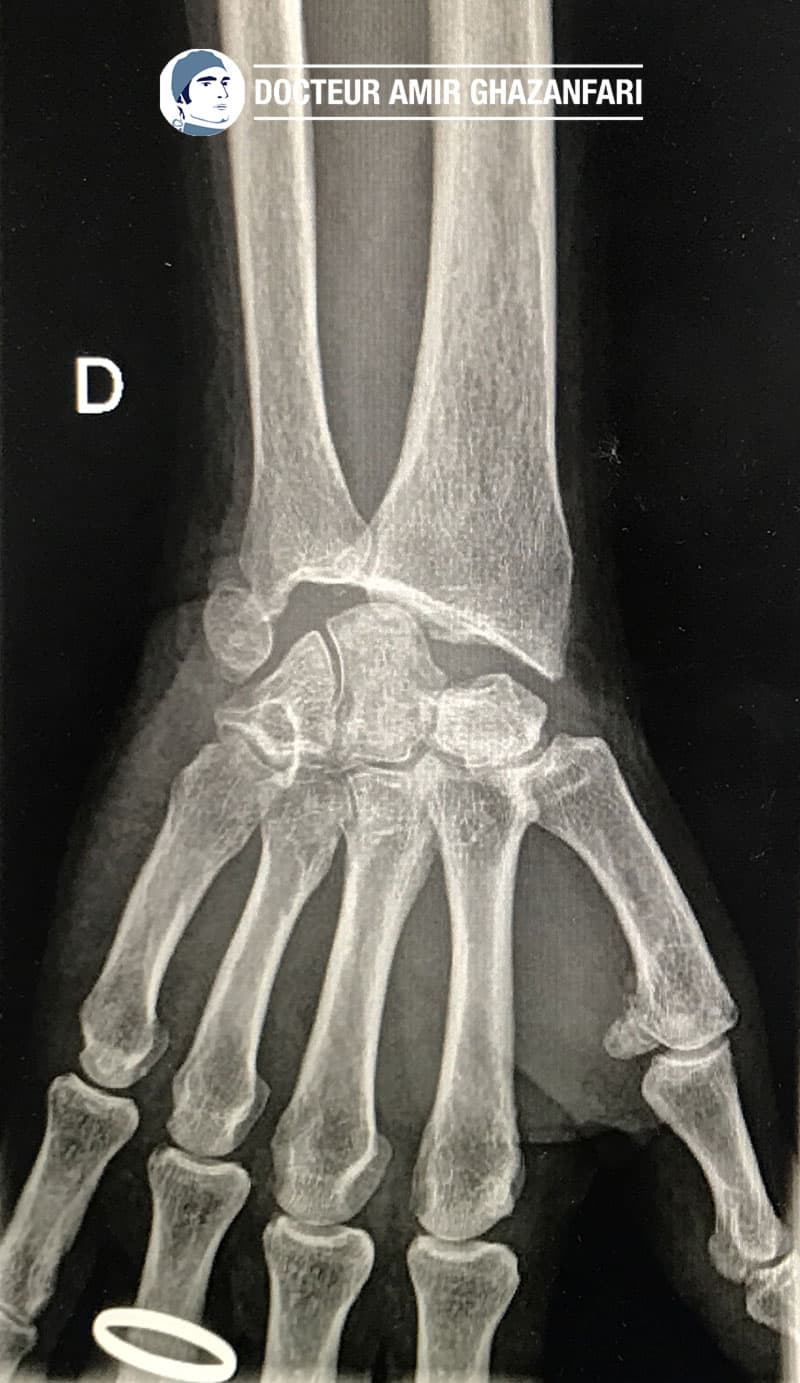 Arthrose du poignet - Figure 2. Résultat d'une résection de la première rangée du carpe avec création d'une nouvelle articulation entre le capitatum et le radius