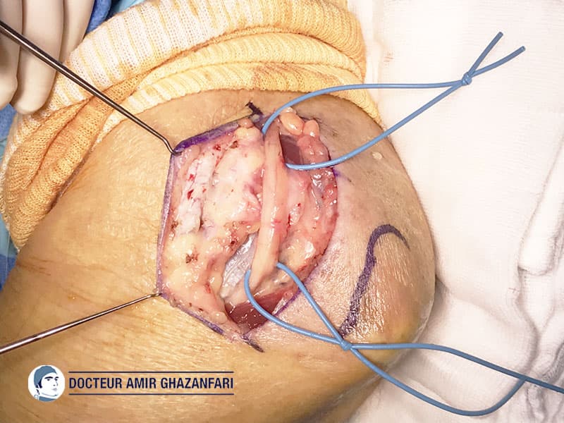 Compression du nerf ulnaire au coude - Figure 4. Prélèvement d'un lambeau graisseux afin de stabiliser le nerf ulnaire