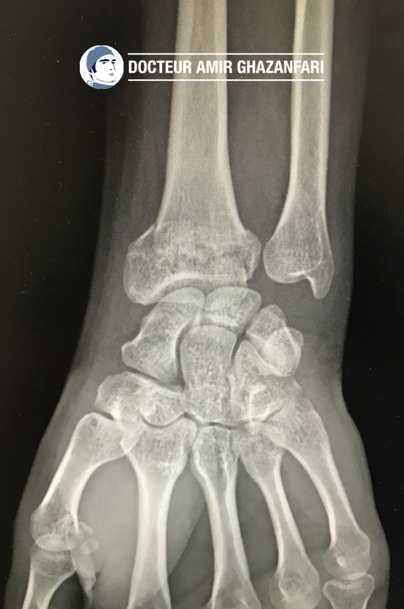 Image 1 Fracture du poignet - Figure 4. Fracture de l'extrémité inférieure du radius déplacée, à bascule postérieure