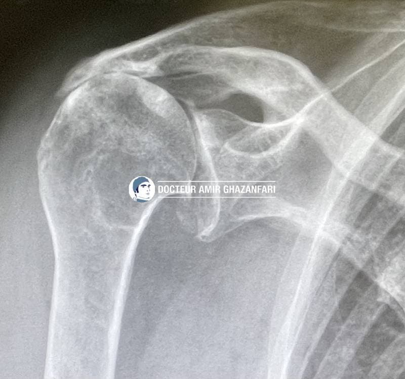 Prothèse d'épaule - Figure 4. Omarthrose excentrée, témoignant d'une rupture massive et ancienne de la coiffe des rotateurs