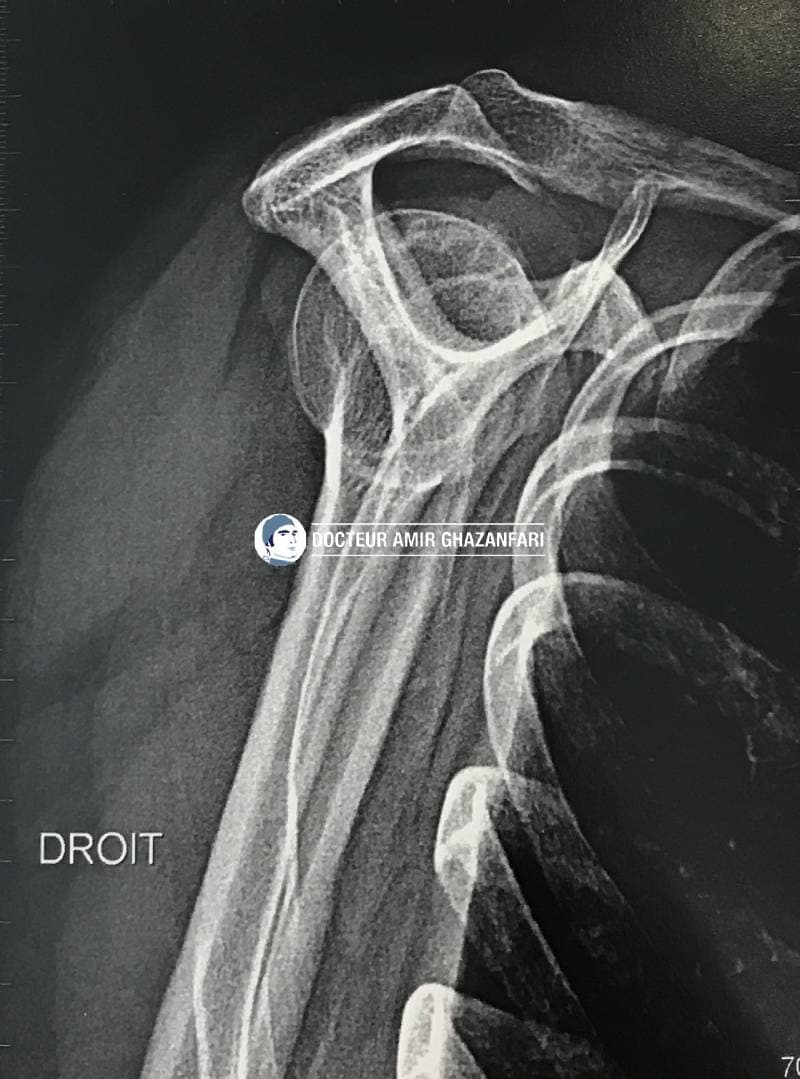 Image 1 Rupture de la coiffe des rotateurs - Figure 4. Radiographies de l'épaule: important bec acromial (image de gauche), arthrose acromio-claviculaire (image de droite)