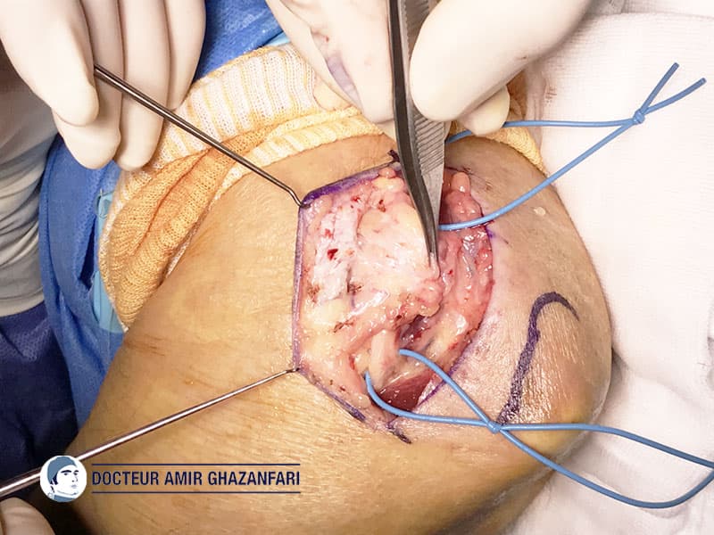 Compression du nerf ulnaire au coude - Figure 5. Stabilisation du nerf ulnaire à l'aide du lambeau graisseux
