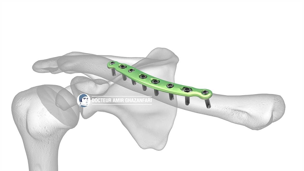 Fracture de clavicule - Figure 5. Réduction et ostéosynthèse de la clavicule par plaque