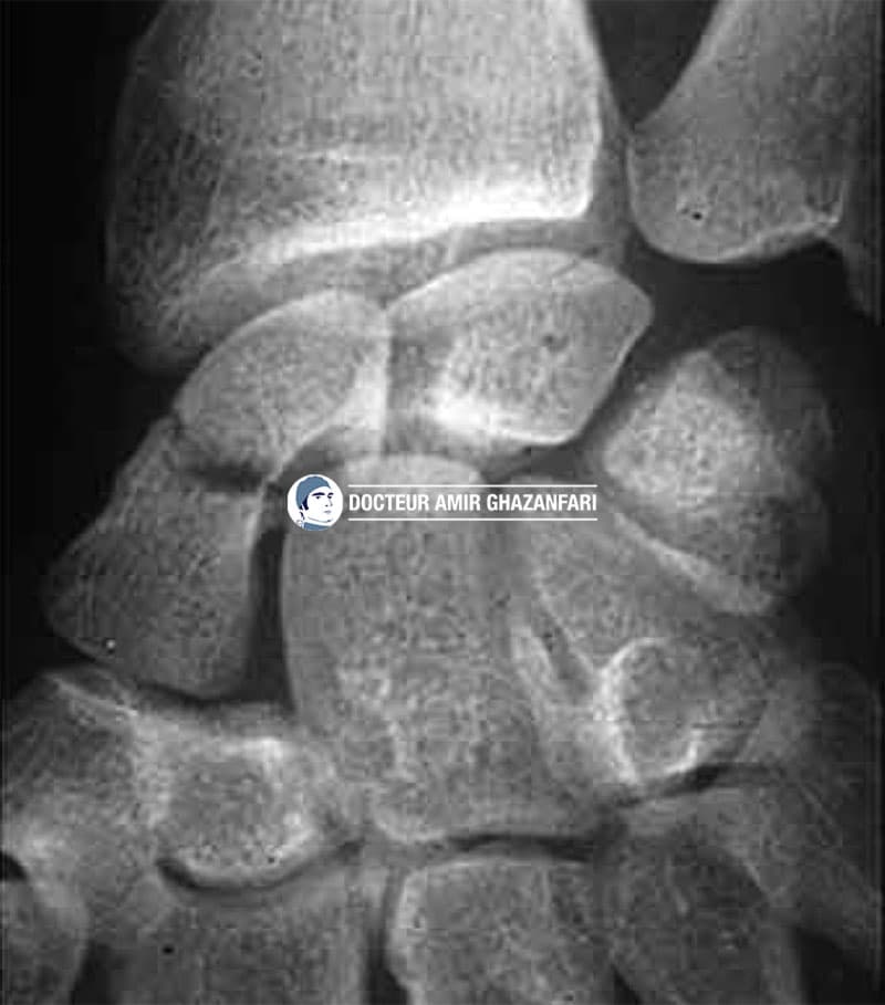 Fracture de scaphoïde - Figure 4. Fracture du scaphoïde sur un cliché radiographique standard