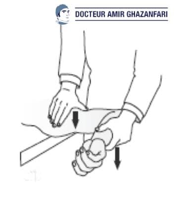 Instabilité antérieure de l'épaule - Figure 5. Test de recentrage (“Relocation test”) permettant de masquer l'appréhension