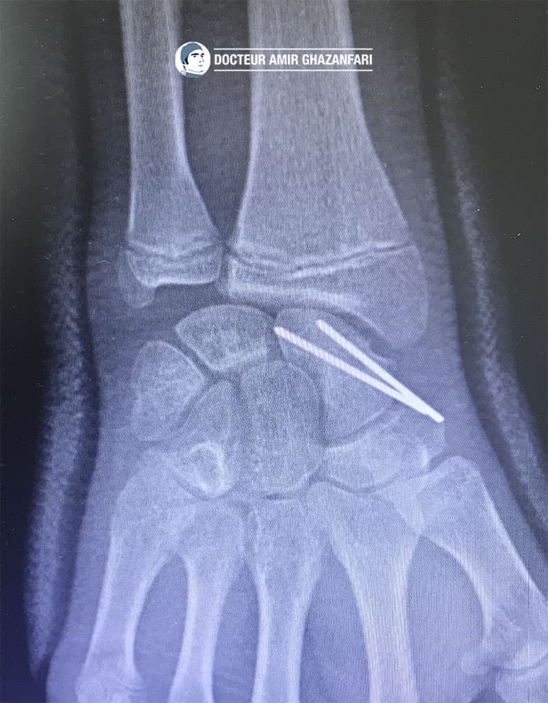 Pseudoarthrose du scaphoïde - Figure 5. Consolidation de pseudarthrose du scaphoïde après greffe et stabilisation par deux broches