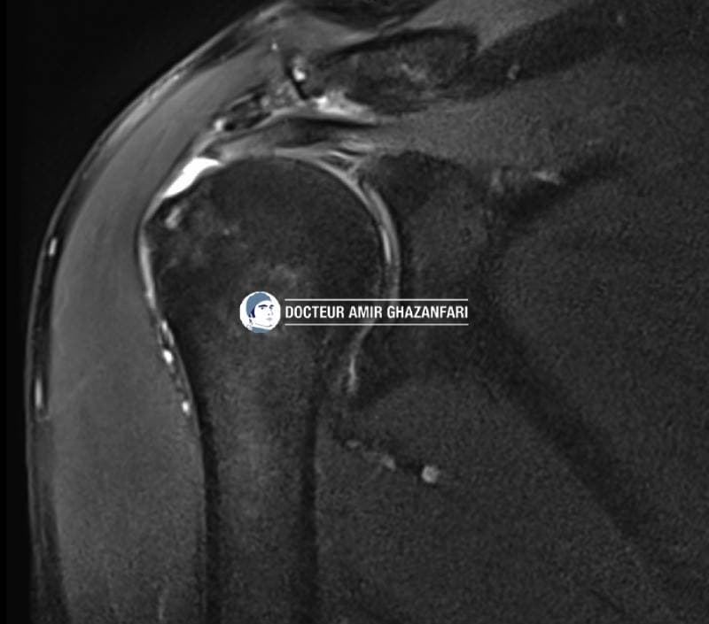 Rupture de la coiffe des rotateurs - Figure 5. IRM de l'épaule: rupture de la coiffe des rotateurs (supra-épineux)