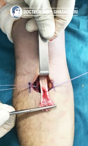 Rupture du tendon du biceps au coude - Figure 5. Mise en place de deux ancres dans la tubérosité radiale permettant ainsi la réinsertion du tendon