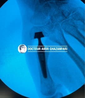 Arthrose du pouce - Figure 5. Aspect radiographique après mise en place d'une prothèse trapézo-métacarpienne