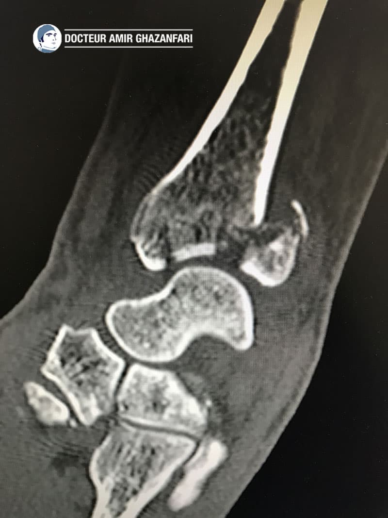 Image 2 Fracture du poignet - Figure 5. Scanner du poignet mettant en évidence une fracture articulaire du radius