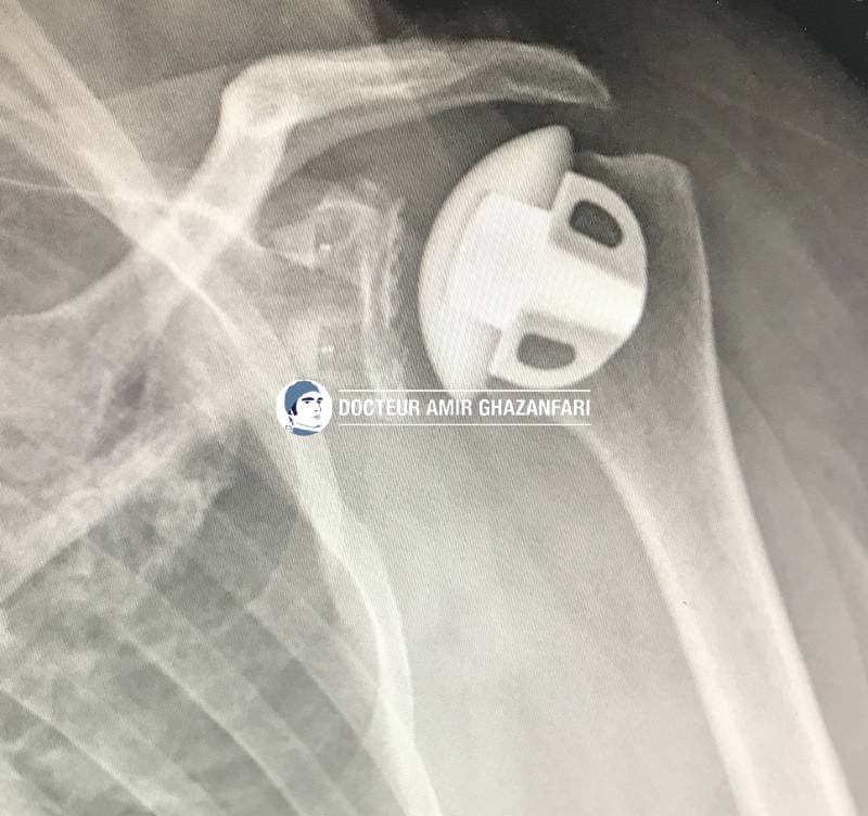 Image 2 Prothèse d'épaule - Figure 5. Omarthrose excentrée, témoignant d'une rupture massive et ancienne de la coiffe des rotateurs