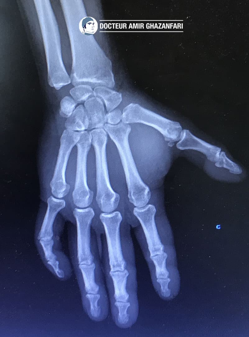 Arthrose du pouce - Figure 6. Aspect radiographique après une trapézectomie