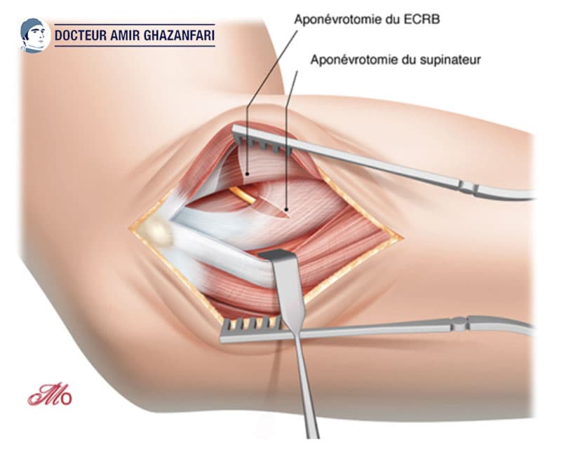 Epicondylite Laterale - Figure 6. Allongement du muscle 2ème radial (ECRB) et ouverture du supinateur permettant ainsi de libérer la branche postérieure du nerf radial (BPNR)