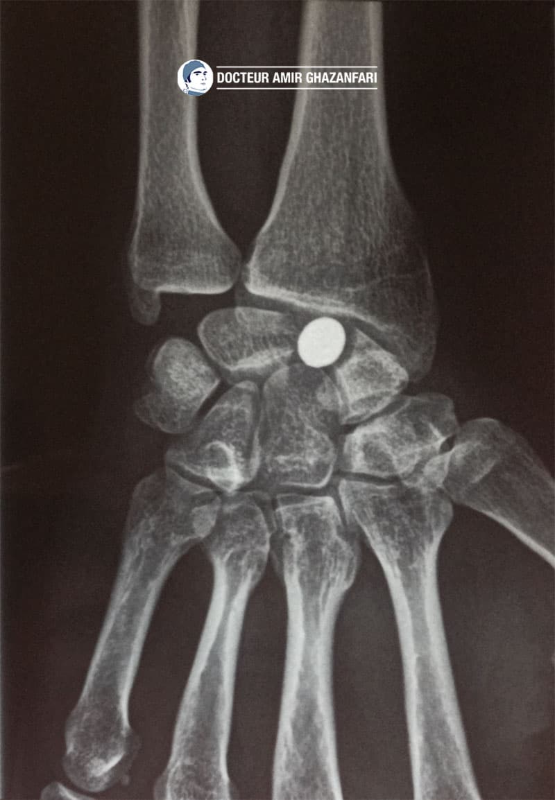 Image 1 Pseudoarthrose du scaphoïde - Figure 6. Implant scaphoïdien en pyrocarbone (APSI) mis en place dans le cadre d'une pseudarthrose proximale du scaphoïde