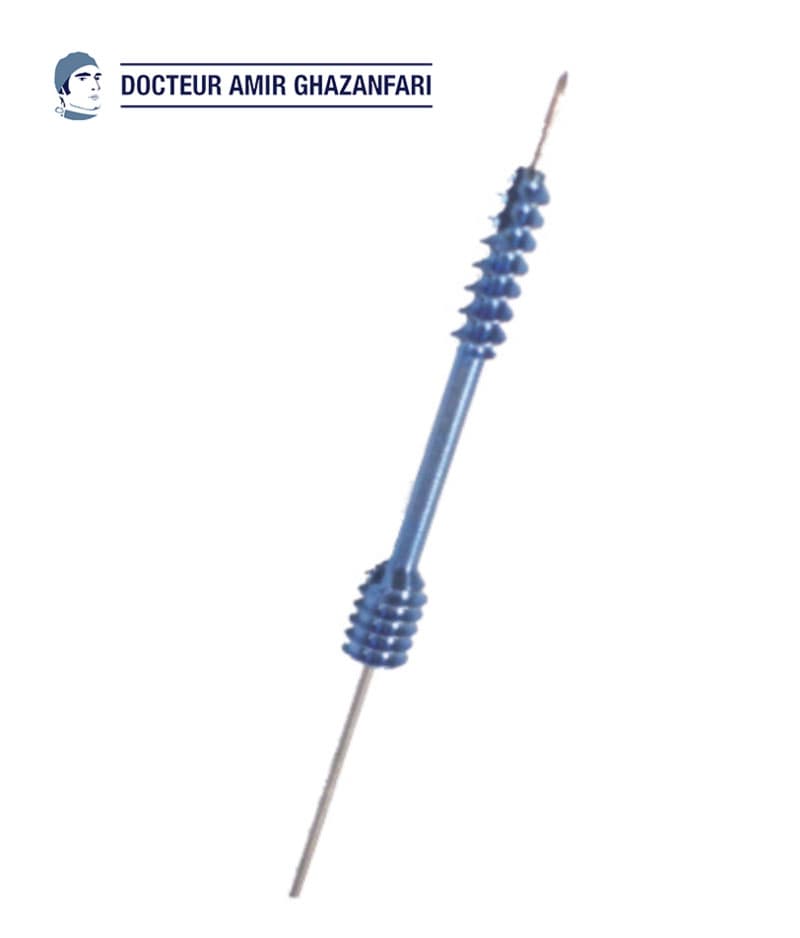 Image 1 Fracture de scaphoïde - Figure 6. Vis en compression positionnée au niveau de la fracture du scaphoïde