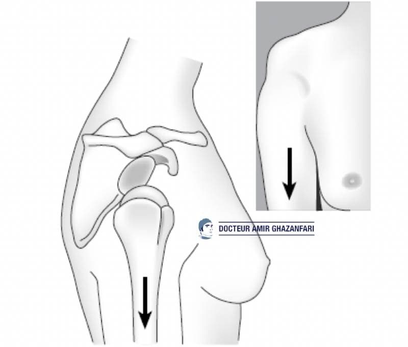 Instabilité antérieure de l'épaule - Figure 7. Test du Sulcus témoignant d'une hyperlaxité inférieure de l'épaule