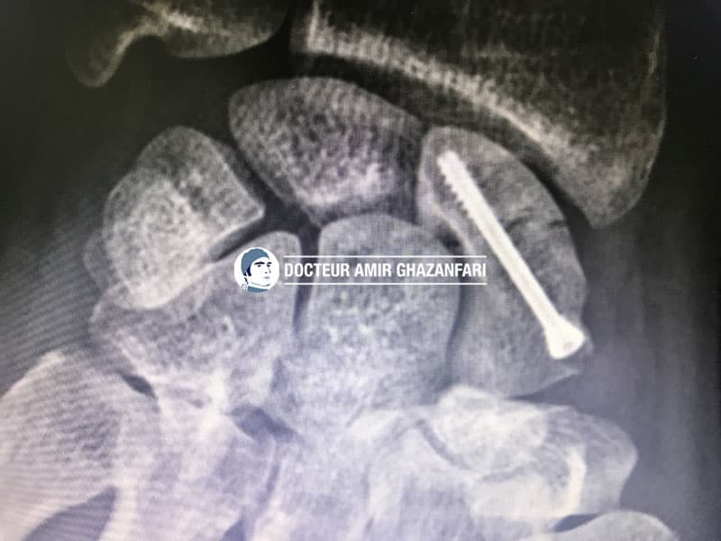 Image 2 Fracture de scaphoïde - Figure 6. Vis en compression positionnée au niveau de la fracture du scaphoïde