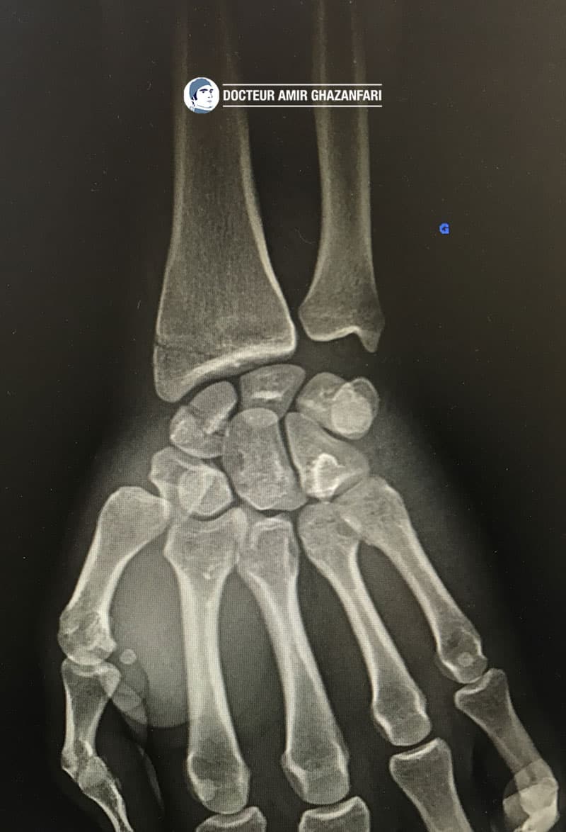 Image 1 Fracture de scaphoïde - Figure 8. Fracture déplacée du scaphoïde nécessitant une chirurgie à ciel ouvert