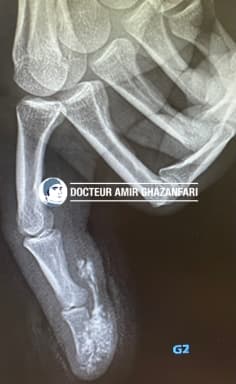 Injection sous pression - Radiographie d'une injection de peinture sous pression. Il s'agit d'une urgence chirurgicale absolue.