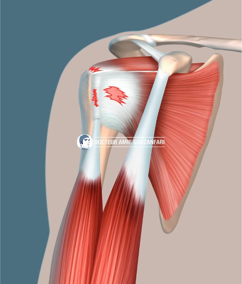Rupture de la coiffe des rotateurs - Figure 3. Tendinopathie de la coiffe des rotateurs et du tendon du long biceps
