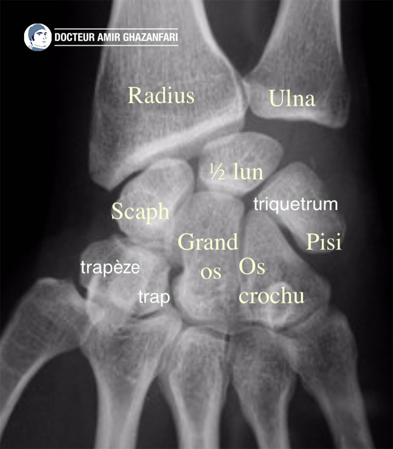 Arthrose du poignet - Figure 1. Anatomie osseuse du poignet