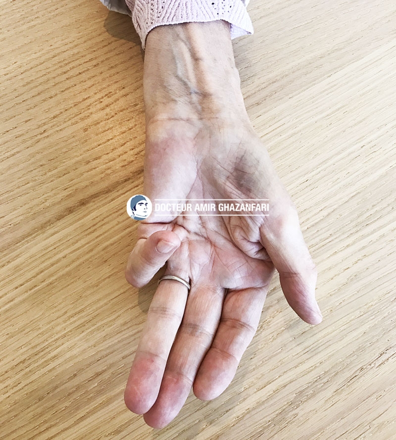 Image 2 Maladie de Dupuytren - Figure 1. Maladie de Dupuytren de l'auriculaire. Notez la présence d'une importante bride au niveau de la paume responsable d'une importante perte de l'extension du doigt.