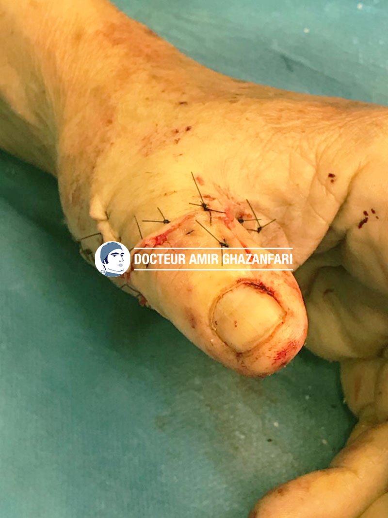 undefined - Plaie délabrante du pouce avec fracture ouverte ayant été suturée au bloc opératoire