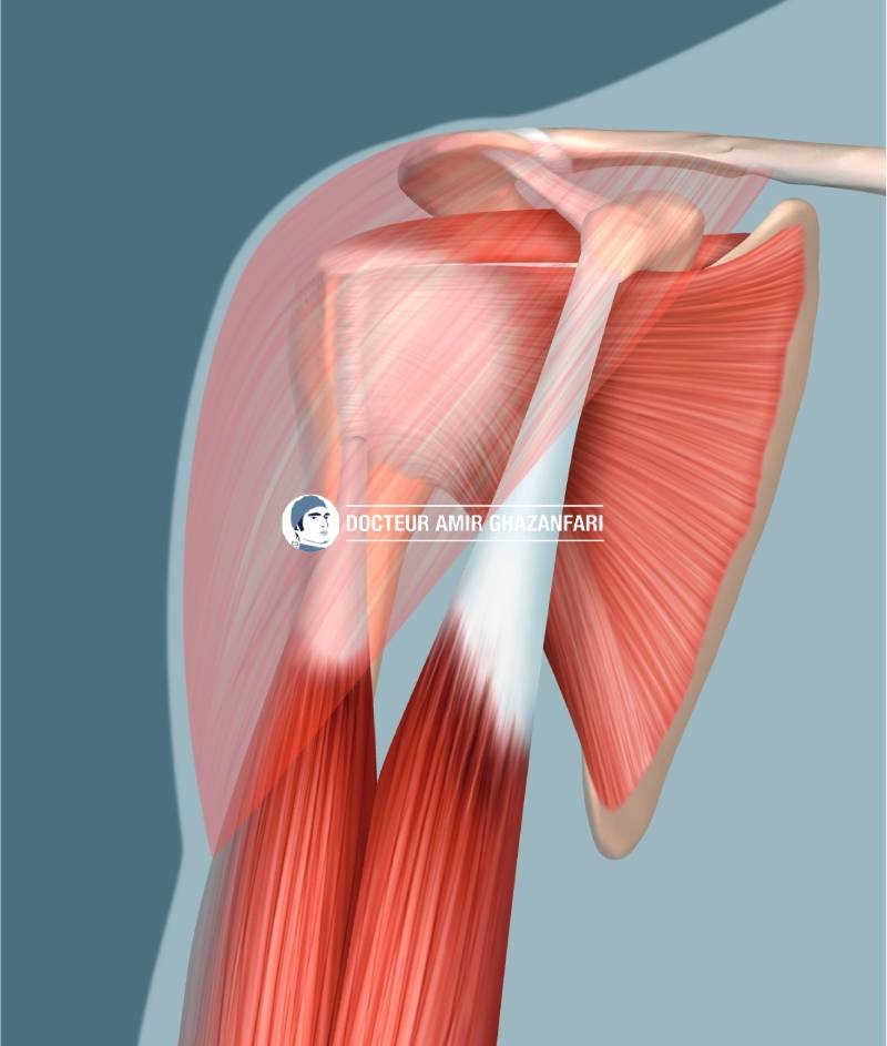 Image 1 Prothèse d'épaule - Figure 2. Muscles de l'épaule: la coiffe des rotateurs (sous-scapulaire, supra-épineux, infra-épineux, petit rond), le muscle deltoïde et le muscle biceps brachial