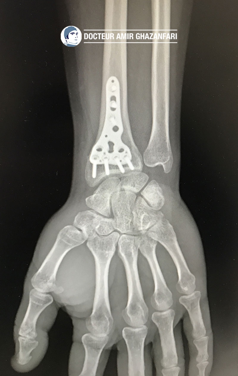 Fracture du poignet - Figure 7. Plaque antérieure de poignet verrouillée pour fracture du radius
