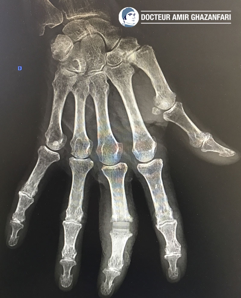 Arthrose des doigts - Figure 4. Prothèse en silicone au niveau de l'articulation inter-phalangienne proximale du majeur