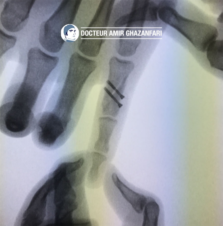 Image 2 Fracture de la main - Fracture déplacée et instable de la première phalange de l’auriculaire traitée par un double vissage en compression