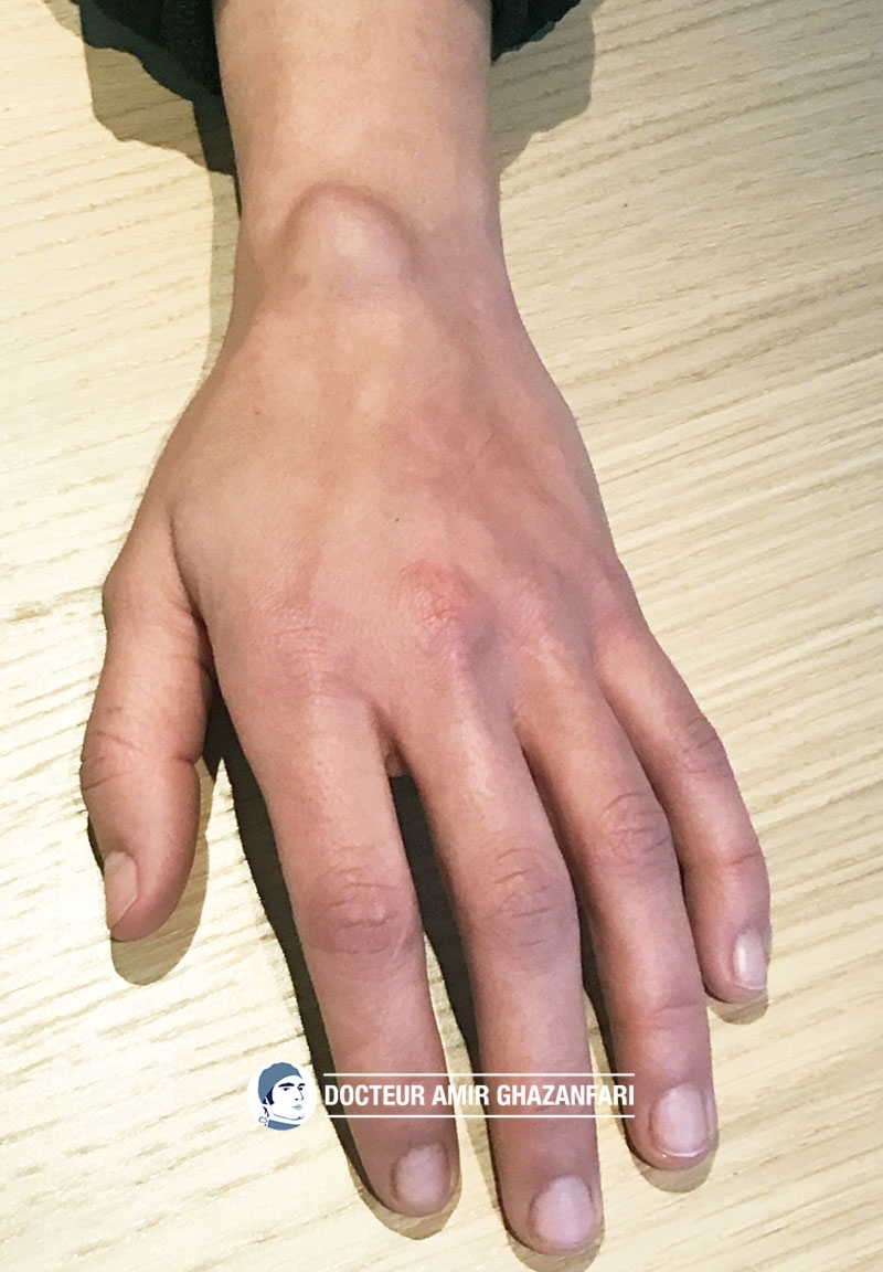 Image 1 Kyste du poignet - Figure 1. Volumineux kyste dorsal du poignet responsable d'une gêne esthétique et fonctionnelle