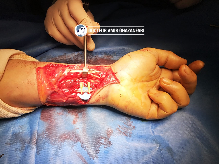 undefined - Plaie du poignet avec section de l’artère ulnaire suturée au bloc opératoire