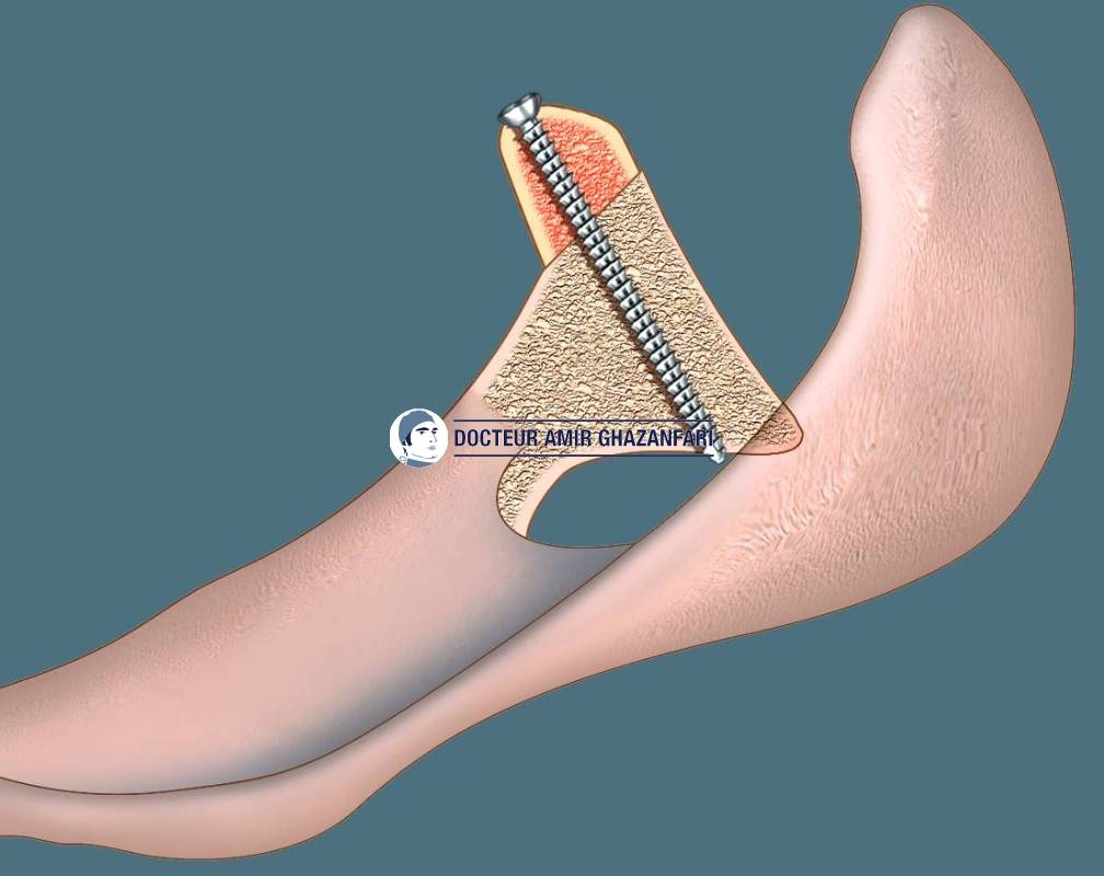 Image 3 Instabilité antérieure de l'épaule - Figure 10. Stabilisation chirurgicale de l'épaule par une butée osseuse selon Latarjet, prélevée sur la coracoïde